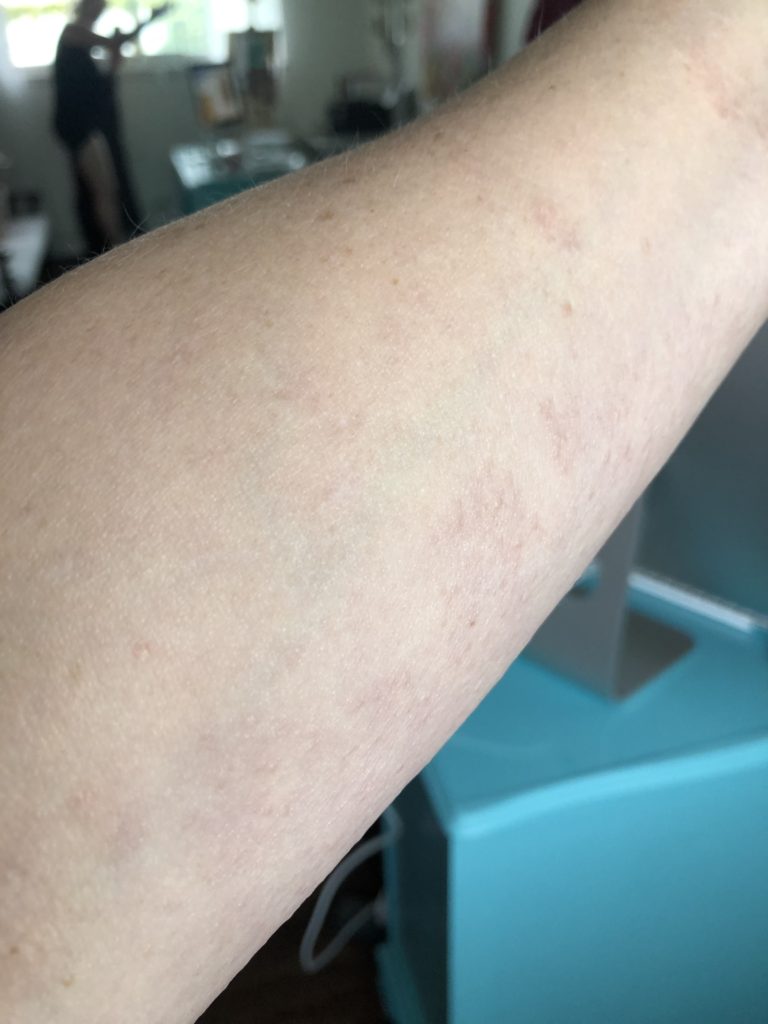 Liver Spots On Forearms